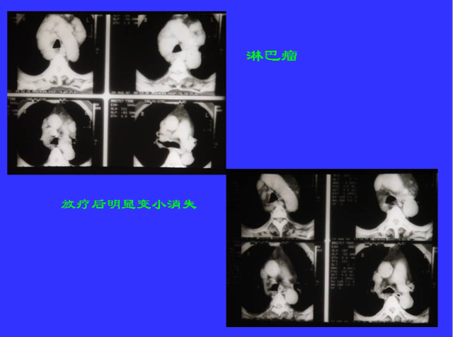 胸部CT阅读与诊断