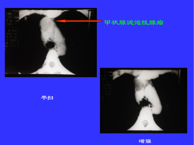 胸部CT阅读与诊断