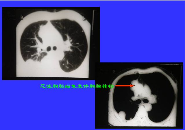 胸部CT阅读与诊断