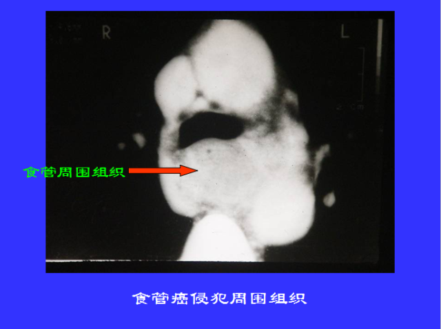 胸部CT阅读与诊断