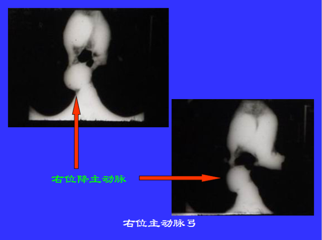 胸部CT阅读与诊断