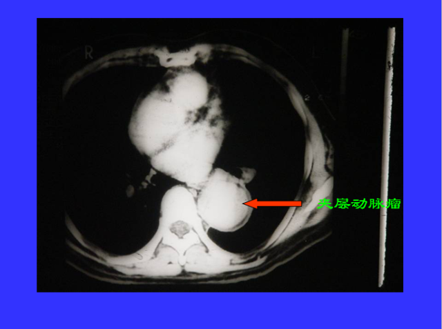 胸部CT阅读与诊断