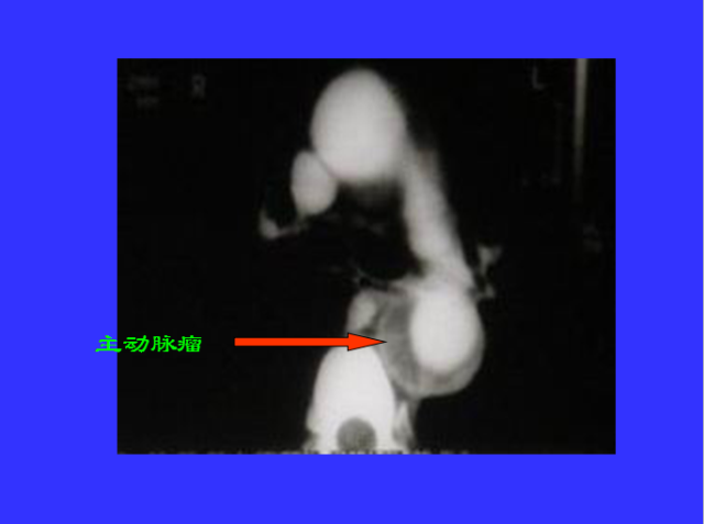 胸部CT阅读与诊断