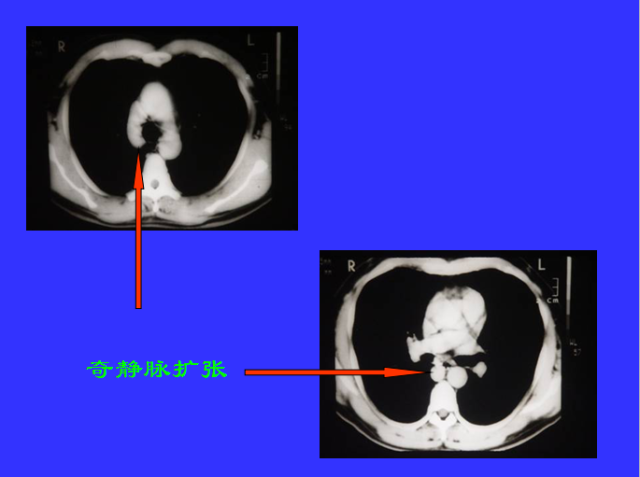 胸部CT阅读与诊断
