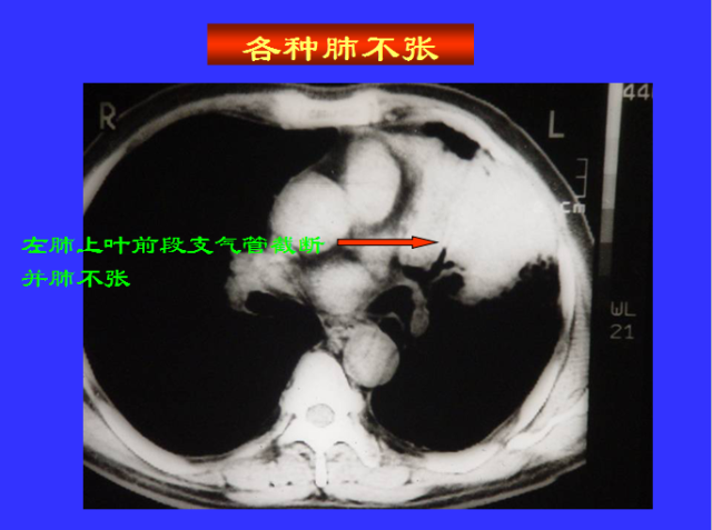 胸部CT阅读与诊断