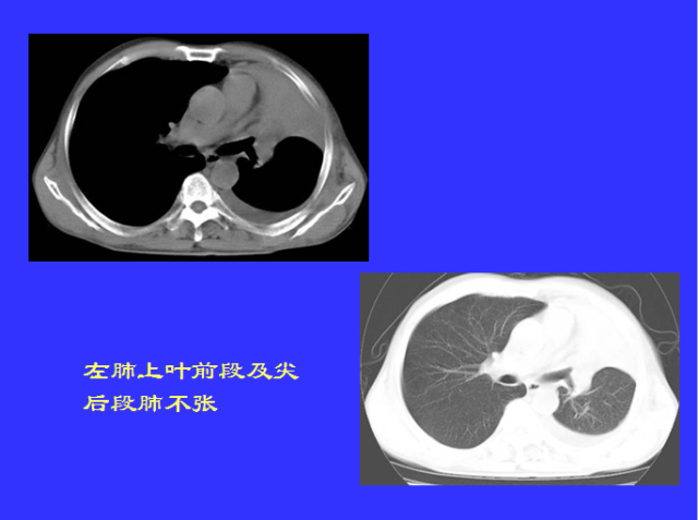 胸部CT阅读与诊断