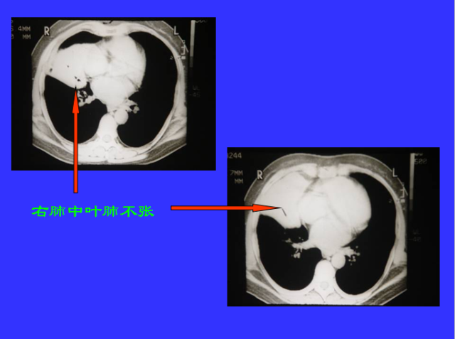 胸部CT阅读与诊断