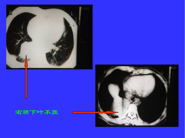 胸部CT阅读与诊断