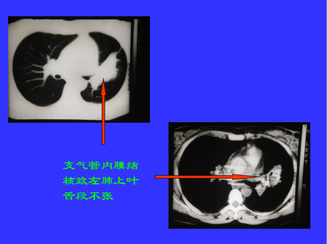 胸部CT阅读与诊断