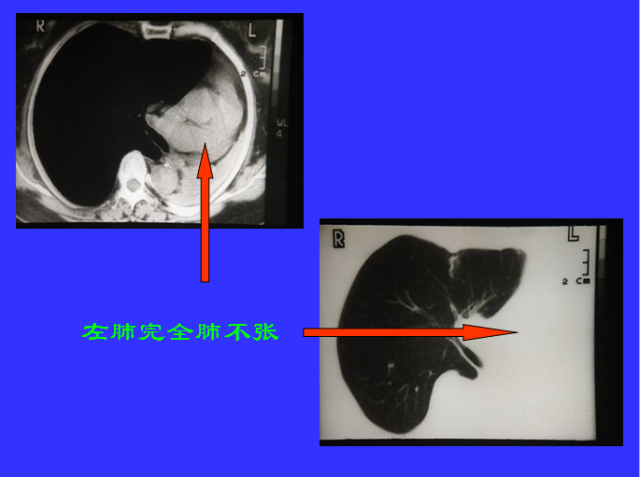 胸部CT阅读与诊断