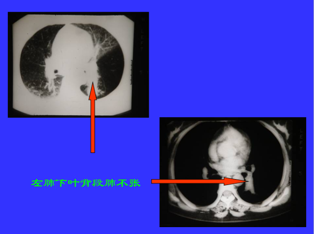 胸部CT阅读与诊断