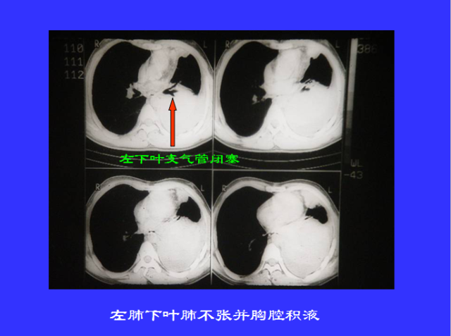 胸部CT阅读与诊断
