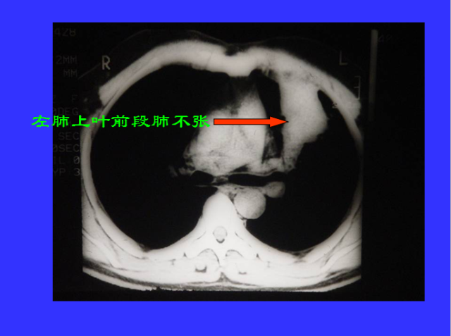 胸部CT阅读与诊断