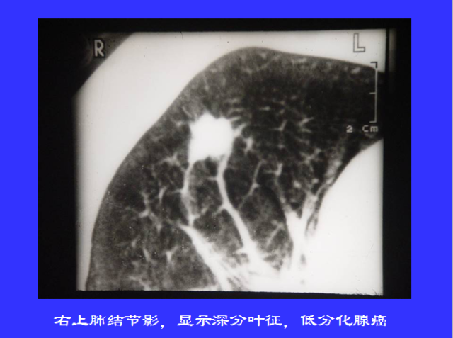 胸部CT阅读与诊断