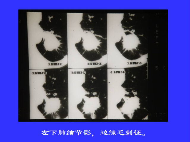 胸部CT阅读与诊断