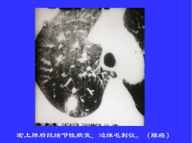 胸部CT阅读与诊断