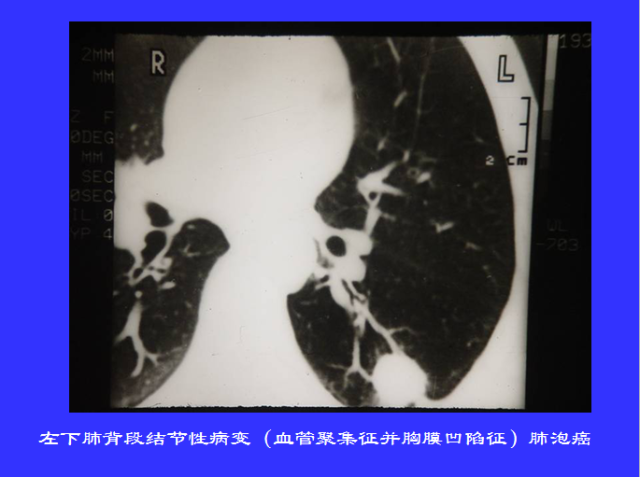 胸部CT阅读与诊断