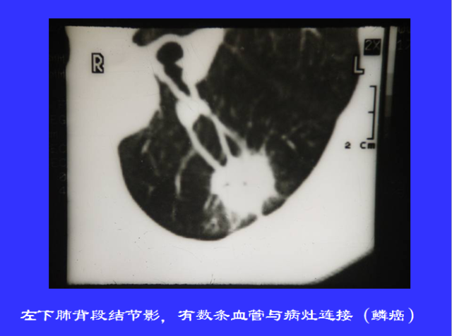 胸部CT阅读与诊断