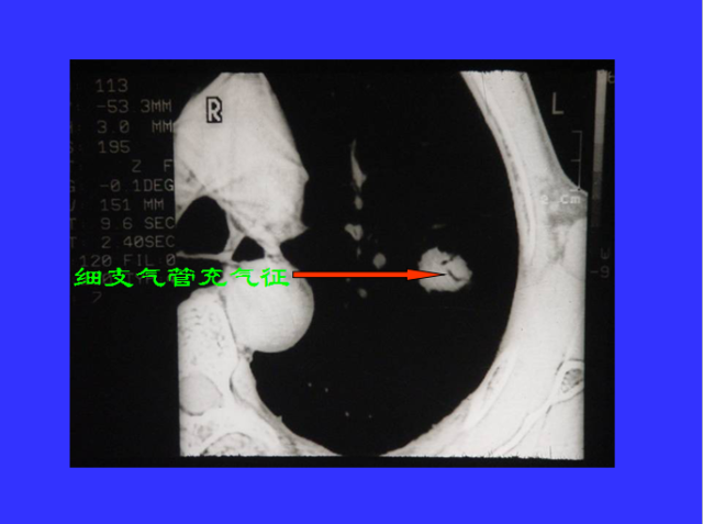 胸部CT阅读与诊断