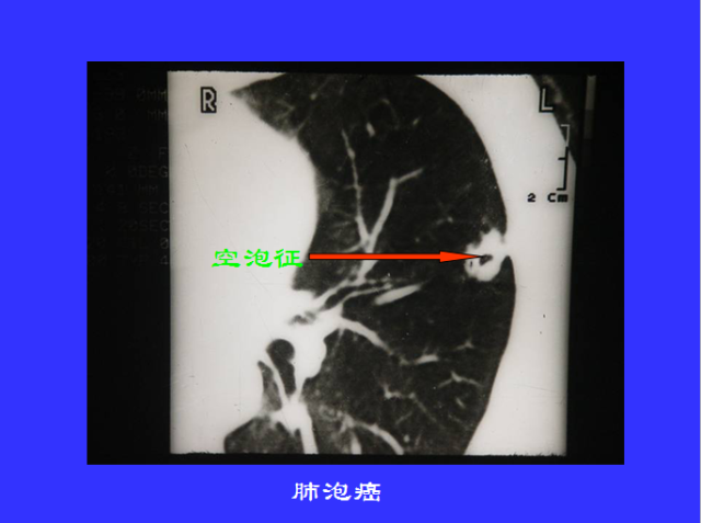 胸部CT阅读与诊断