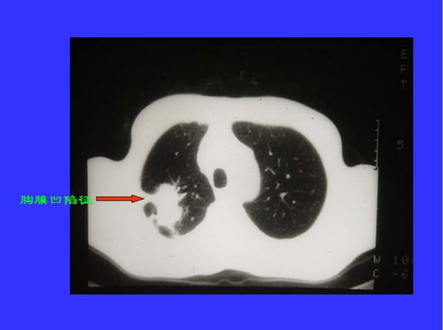 胸部CT阅读与诊断