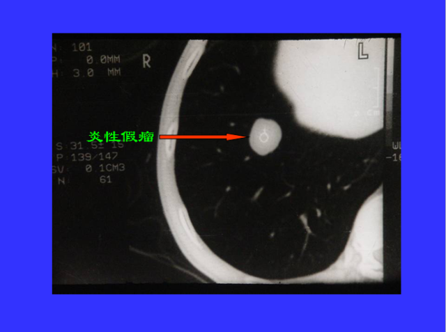 胸部CT阅读与诊断