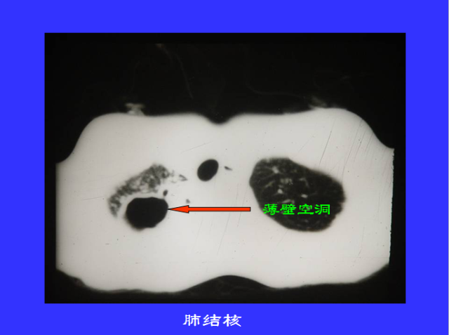 胸部CT阅读与诊断