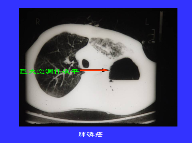 胸部CT阅读与诊断