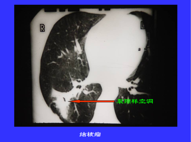 胸部CT阅读与诊断
