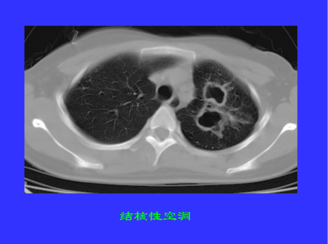 胸部CT阅读与诊断