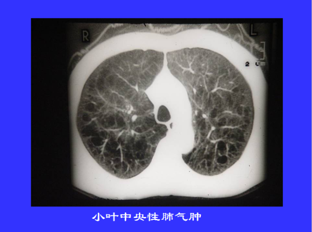 胸部CT阅读与诊断