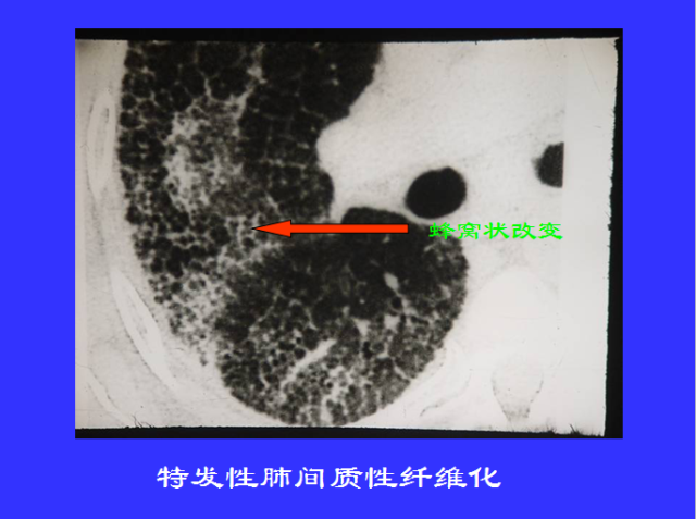 胸部CT阅读与诊断