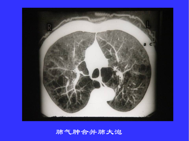 胸部CT阅读与诊断