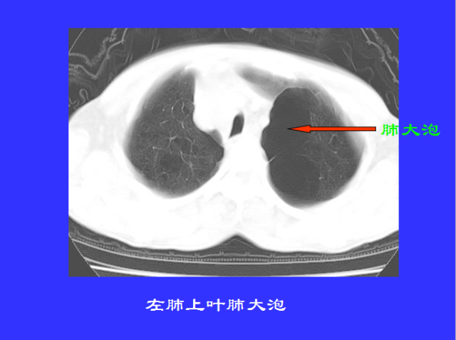 胸部CT阅读与诊断