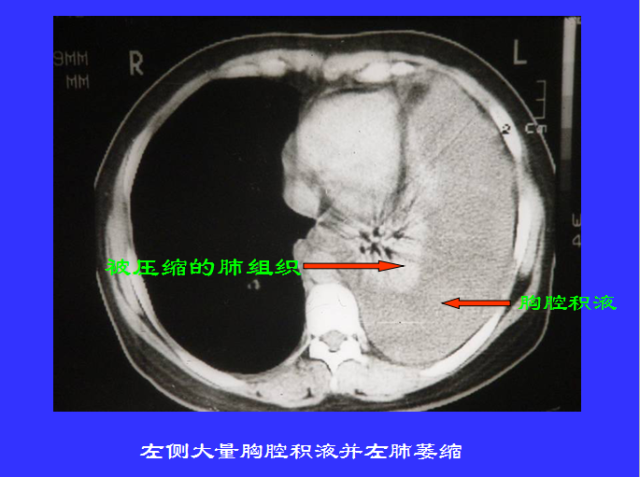 胸部CT阅读与诊断
