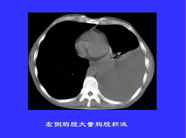 胸部CT阅读与诊断