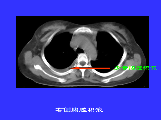 胸部CT阅读与诊断