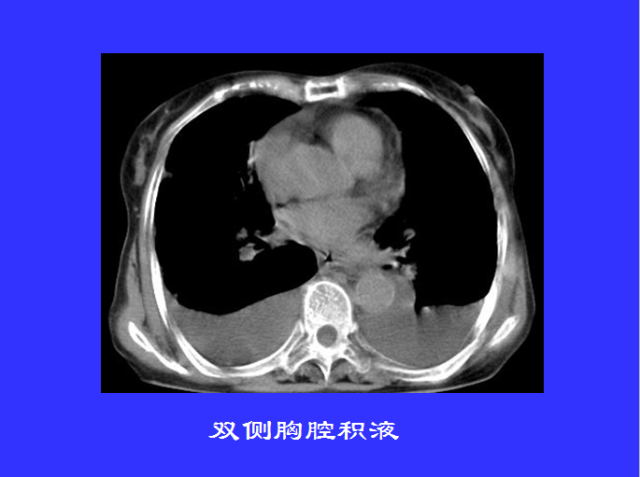 胸部CT阅读与诊断