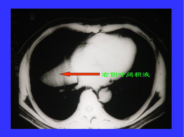 胸部CT阅读与诊断