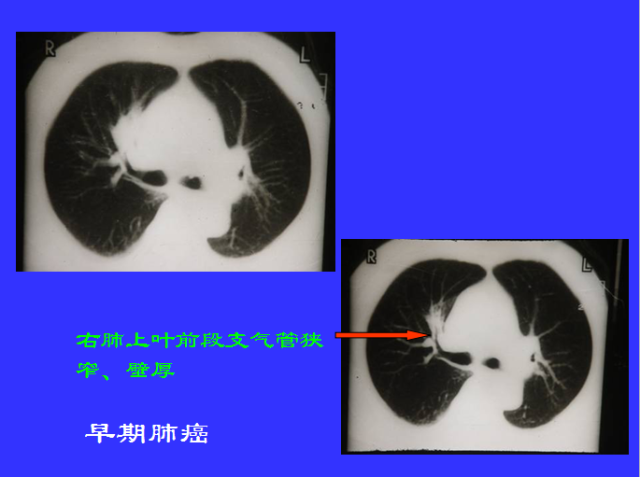 胸部CT阅读与诊断