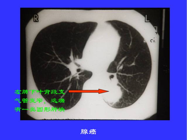 胸部CT阅读与诊断