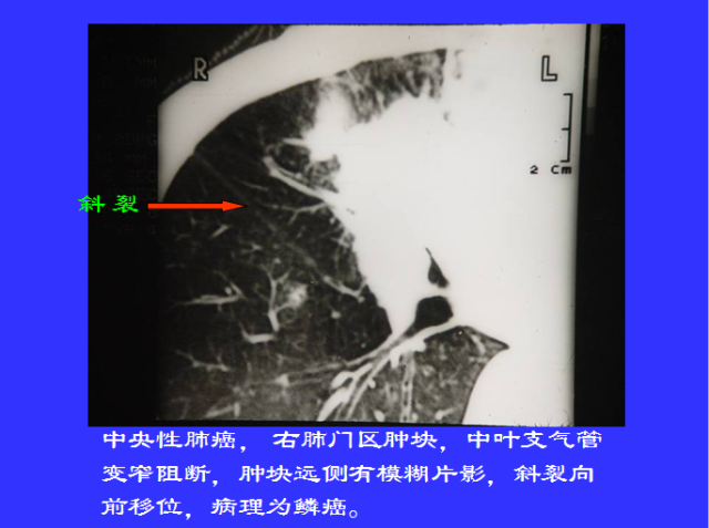 胸部CT阅读与诊断