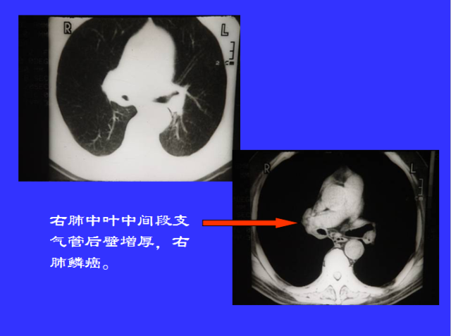 胸部CT阅读与诊断