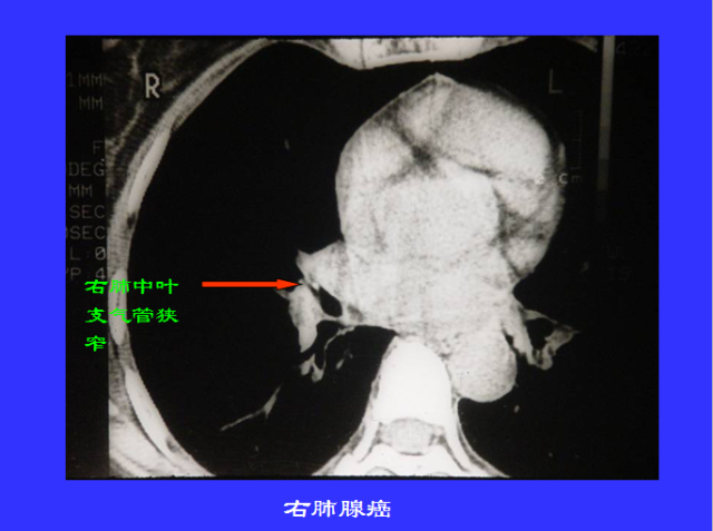 胸部CT阅读与诊断