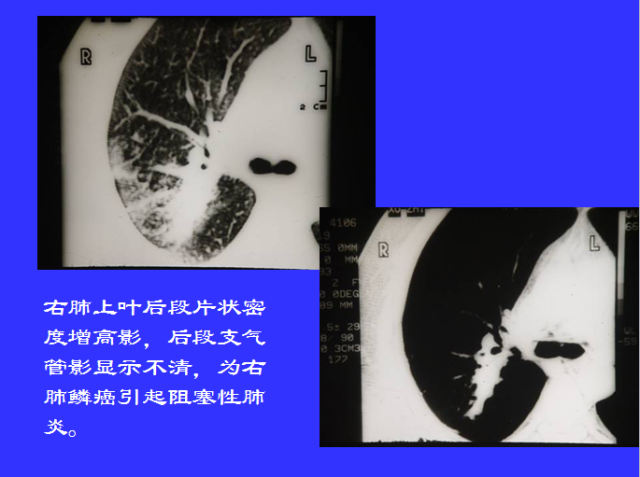 胸部CT阅读与诊断