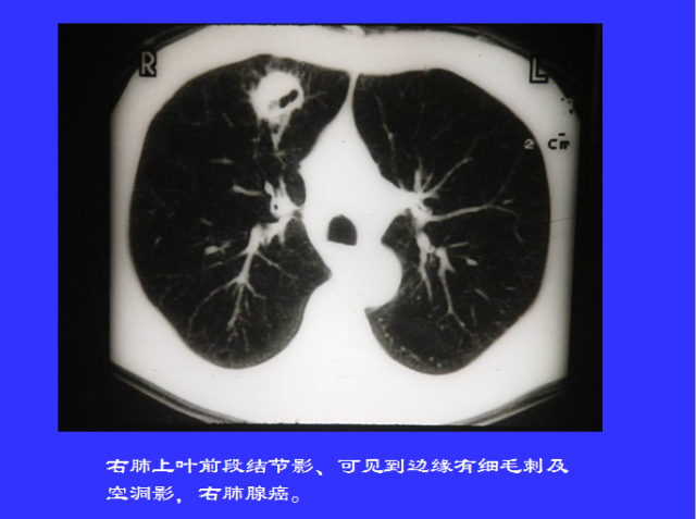 胸部CT阅读与诊断