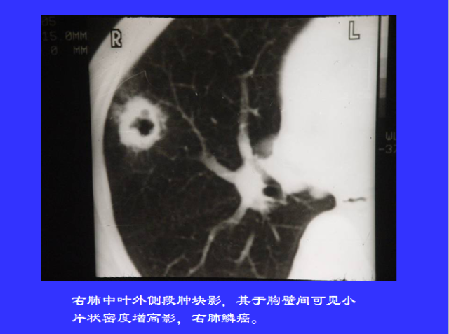 胸部CT阅读与诊断