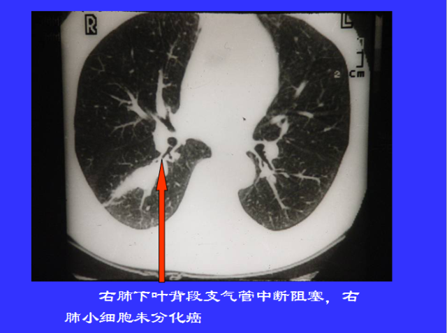 胸部CT阅读与诊断