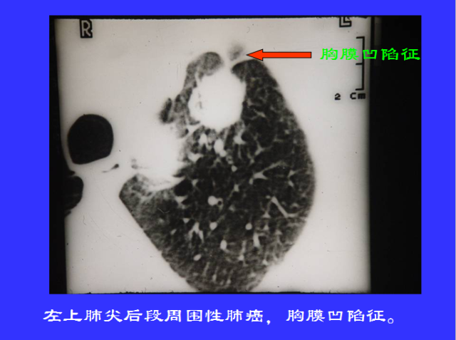 胸部CT阅读与诊断