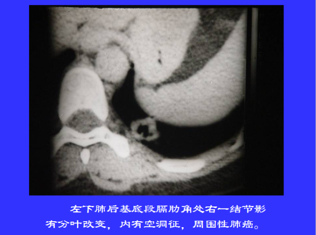 胸部CT阅读与诊断